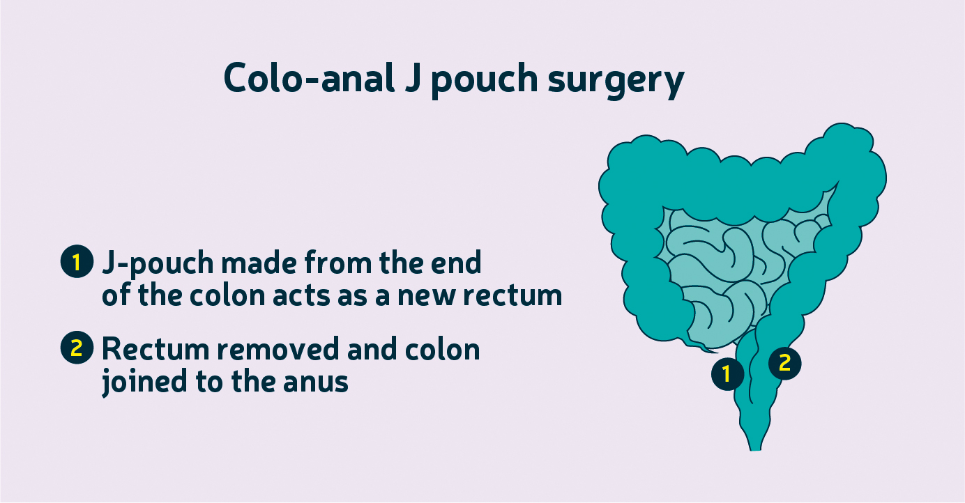 Types of surgery Treatment About bowel cancer Bowel Cancer UK
